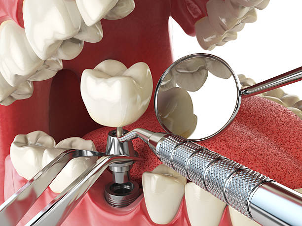 Best Knocked-Out Tooth (Avulsed Tooth) Treatment in Parowan, UT