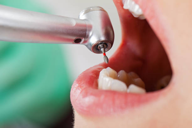Best Dental Abscess Treatment in Parowan, UT